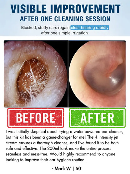 ENT-Approved Home Ear Irrigation Micro-Clinic System – German-Engineered Vortex Pulse Wax Removal Kit Compliant with AAO-HNS Guidelines (Save $1400+ on Clinic Visits!)